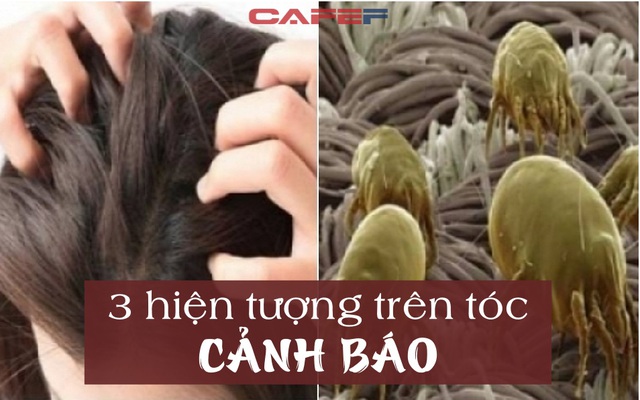 Sáng ngủ dậy thấy TÓC có 3 hiện tượng: Một THỦ PHẠM nguy hiểm đang lẩn trốn trong da đầu, cẩn thận không rụng tóc, lở loét cả đầu