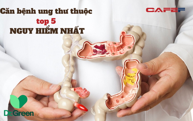 Căn bệnh thuộc top SÁT THỦ hàng đầu tại Việt Nam, người sau 45 tuổi dễ nằm trong tầm ngắm: Bác sĩ nhắc nhở 5 cách ngăn ngừa "hung thần" ung thư gõ cửa