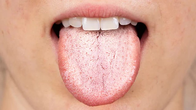 Người có đường huyết cao sẽ có 4 vấn đề này ở miệng: Muốn đường huyết ổn định phải tuân thủ 3 quy tắc này - Ảnh 3.