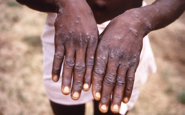Hình ảnh năm 1997 do CDC cung cấp trong cuộc điều tra về đợt bùng phát bệnh đậu mùa khỉ ở Cộng hòa Dân chủ Congo. Ảnh: CDC