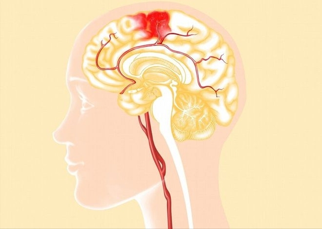 4 triệu chứng cho thấy máu cung cấp cho não không đủ, bác sĩ khuyến cáo thực hiện 4 điều nếu không muốn bị sa sút trí tuệ - Ảnh 1.