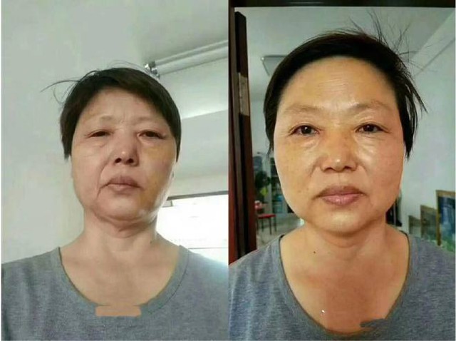 Người phụ nữ 31 tuổi bị méo miệng, mắt phải không nhắm được chỉ vì thói quen sau khi gội đầu mà nhiều người vẫn chủ quan mắc phải  - Ảnh 2.