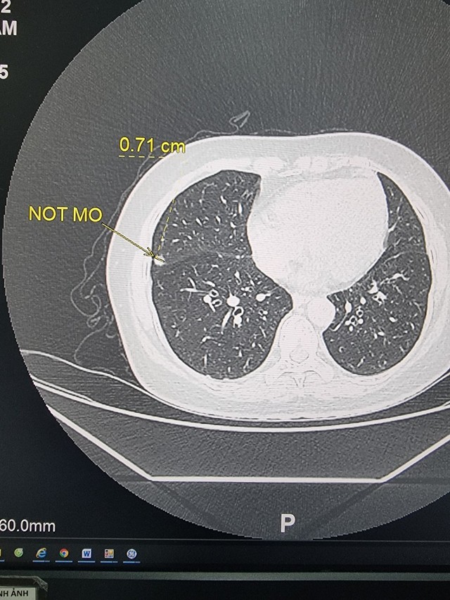 2 vợ chồng cùng mắc ung thư phổi: Bác sĩ chỉ ra nguyên nhân - Ảnh 1.