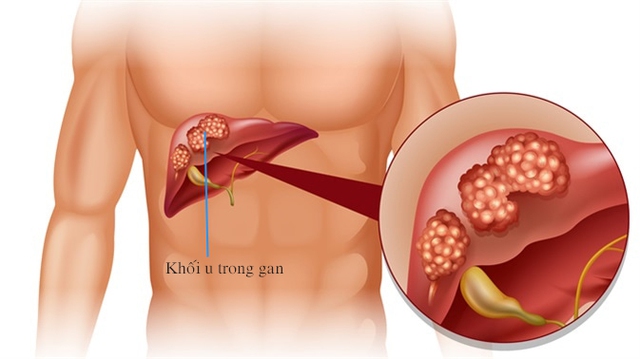 Cặp vợ chồng 35 tuổi cùng nghi ngờ mắc ung thư gan, bác sĩ bệnh viện K chỉ ra nguyên nhân là thói quen tiết kiệm mà nhiều người cũng mắc phải - Ảnh 1.