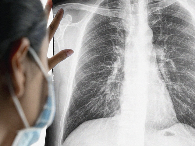 2 yếu tố tăng nguy cơ mắc ung thư phổi đang 'bủa vây' người Việt: Phòng tránh thế nào?