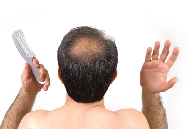 Lợi ích ít biết của đàn ông hói đầu: Vừa tiết kiệm, vừa phòng ngay căn bệnh phổ biến hàng đầu ở nam giới - Ảnh 1.