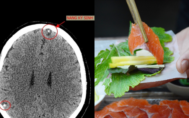 Thường xuyên ăn gỏi cá, hải sản sống, người đàn ông bị sán "làm tổ" trong não