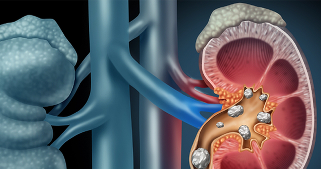 Thói quen tưởng vô hại nhưng lại là nguyên nhân khiến thận chứa cả "túi sỏi"