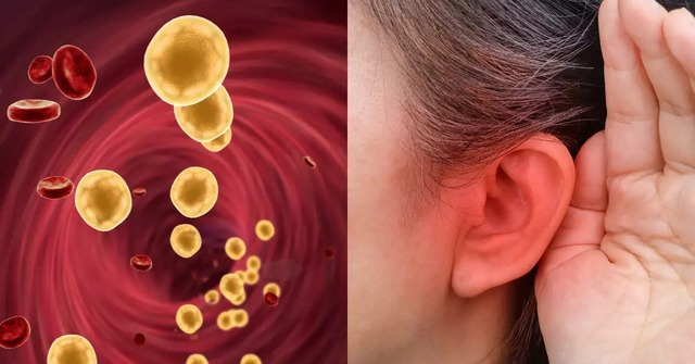 Khi mỡ máu tăng cao, tai sẽ phát ra 3 “tín hiệu” cảnh báo đỏ