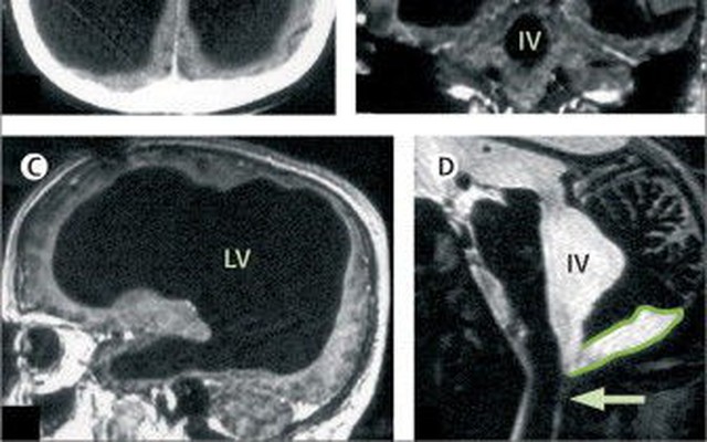 Kinh ngạc phát hiện người đàn ông gần như không có não, trong khoang sọ chỉ toàn chất lỏng vẫn sống bình thường: Nguyên nhân vì sao?