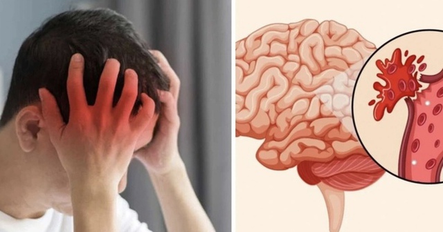 Sinh viên 22 tuổi đột quỵ lúc 4 giờ sáng phải lên bàn mổ ngay lập tức: Những dấu hiệu DỄ THẤY và ĐƯỢC BÁO TRƯỚC, nhưng bị xem nhẹ