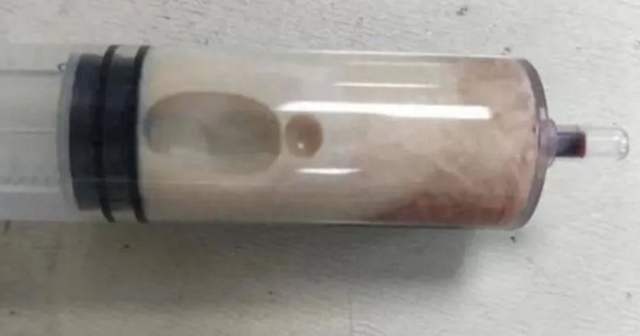 Thanh niên nhập viện sau bữa lẩu nướng, bác sĩ rút ra thứ chất lỏng khiến ai cũng rùng mình