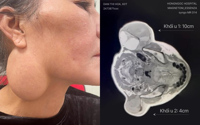 Những thách thức trong phẫu thuật khối u tuyến nước bọt mang tai