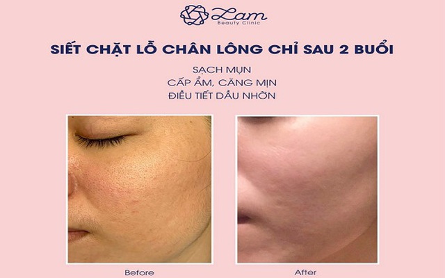 Điều trị thu nhỏ chân lông Juvenix20