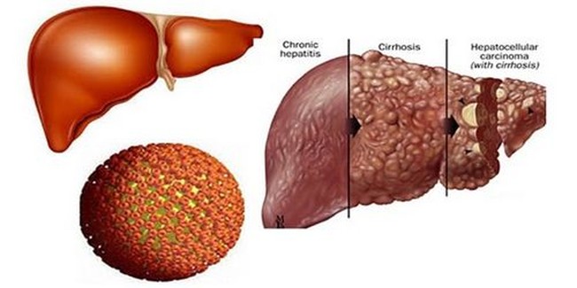 Những điều cần biết về bệnh viêm gan B