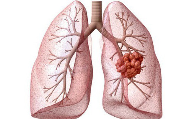 Ung thư phổi gây tử vong số 1: Những dấu hiệu cảnh báo sớm tuyệt đối không nên "lờ đi"