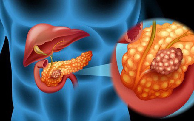 6 dấu hiệu của ung thư tuyến tụy: Căn bệnh cực nguy hiểm vì tỷ lệ