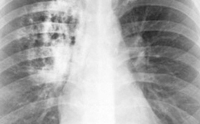 Tỷ lệ mắc ung thư phổi ở Việt Nam rất cao: "Thủ phạm" chính là một thói quen đơn giản