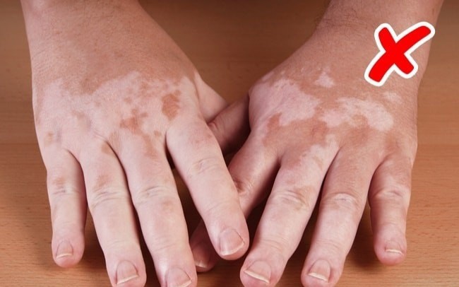 Cẩn thận với những bệnh nguy hiểm được thông báo qua dấu hiệu bất thường trên làn da