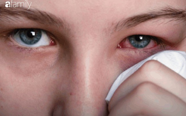 Đau mắt đỏ: Chớ dại làm 3 việc sau nếu không muốn bị loét giác mạc, mù vĩnh viễn