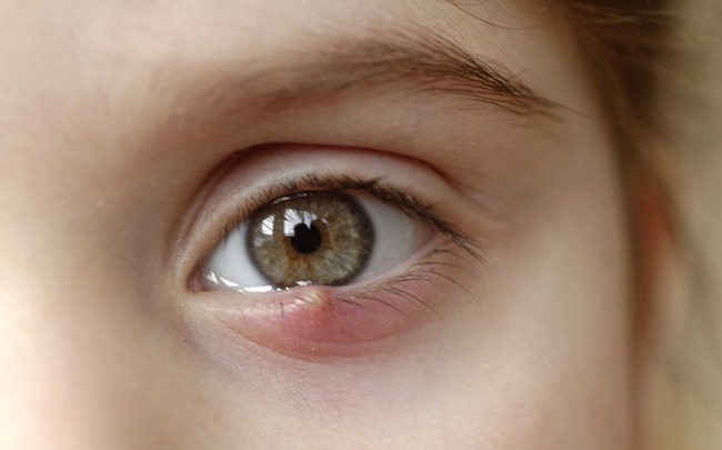8 dấu hiệu cảnh báo bệnh tật được “khắc” rất rõ trên mắt: Ai cũng cần đọc để đối chiếu với sức khỏe bản thân