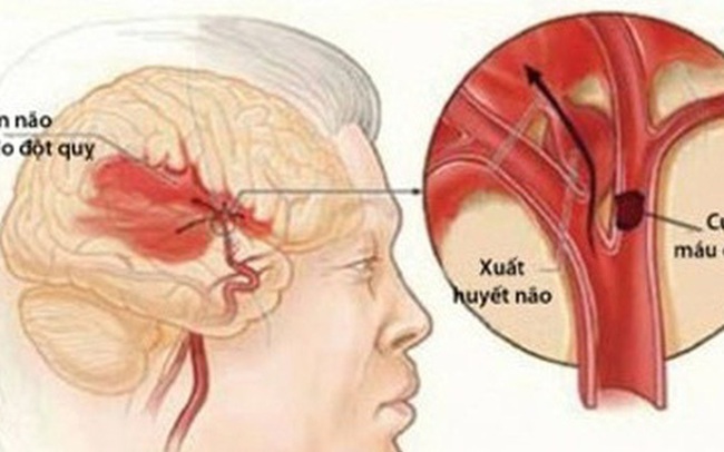 Căn bệnh gây chết não chỉ trong thời gian ngắn: Người hút thuốc lá cần bỏ ngay vì có nguy cơ cao Căn bệnh gây chết não chỉ trong thời gian ngắn: Người hút thuốc lá cần bỏ ngay vì có nguy cơ cao