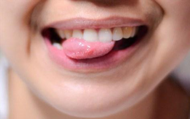 Lưỡi không chỉ giúp bạn nói mà ngay cả các loại bệnh nguy hiểm nó cũng “lên tiếng” được thông qua 5 dấu hiệu Lưỡi không chỉ giúp bạn nói mà ngay cả các loại bệnh nguy hiểm nó cũng “lên tiếng” được thông qua 5 dấu hiệu