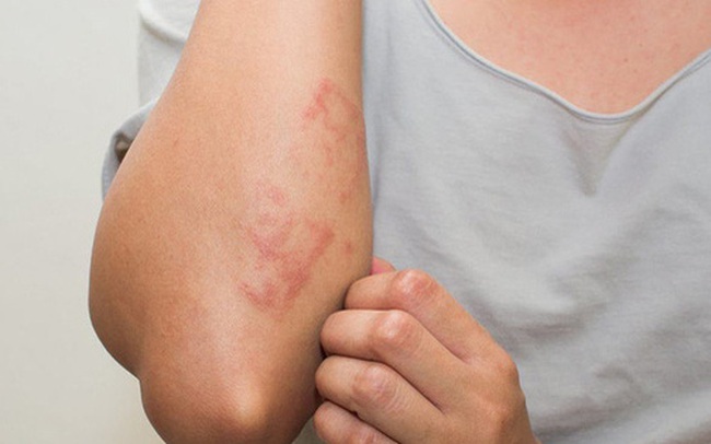 Bệnh thận nguy hiểm vì gây mất chức năng vĩnh viễn: BS khuyến cáo 10 dấu hiệu sớm chớ bỏ qua Bệnh thận nguy hiểm vì gây mất chức năng vĩnh viễn: BS khuyến cáo 10 dấu hiệu sớm chớ bỏ qua