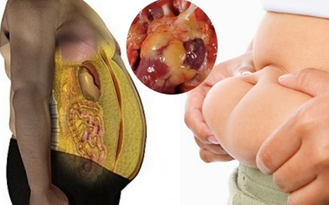 Đừng lười biếng nếu bạn bị mỡ nội tạng: Kiên trì với bài tập này thì bệnh có thể đảo ngược Đừng lười biếng nếu bạn bị mỡ nội tạng: Kiên trì với bài tập này thì bệnh có thể đảo ngược