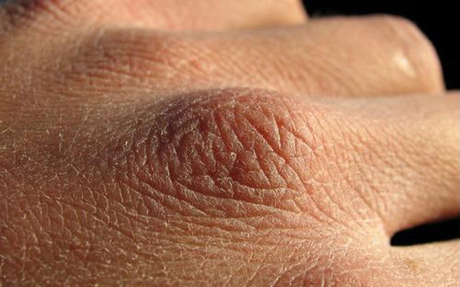 Chuyên gia da liễu tiết lộ 3 bệnh về da thường gặp vào mùa đông, muốn phòng tránh phải làm đủ 10 điều quan trọng