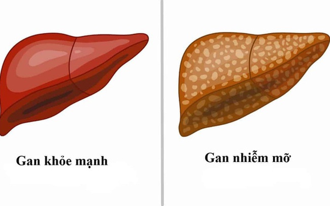 Gan nhiễm mỡ không chỉ do ăn nhiều chất béo: Đây là 4 "kẻ thù giấu mặt" cần cảnh giác Gan nhiễm mỡ không chỉ do ăn nhiều chất béo: Đây là 4 "kẻ thù giấu mặt" cần cảnh giác