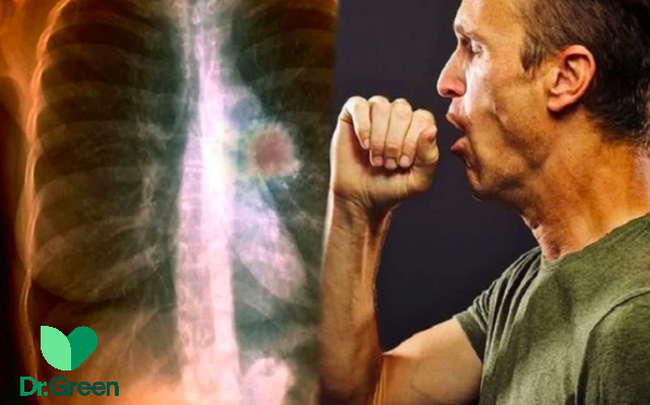 5 kiểu ho cảnh báo sớm ung thư phổi: Rất dễ nhầm với bệnh thông thường, đi khám mới “bật ngửa”, hoá ra ung thư phổi đã ẩn náu trong người từ lâu!