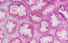 Có 5 dấu hiệu sau, rất dễ mắc ung thư trực tràng: Biết sớm đi khám ngay kẻo muộn!