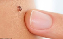 Những dấu hiệu cơ thể cảnh báo ung thư sớm, bạn sẽ phải hối hận nếu bỏ qua