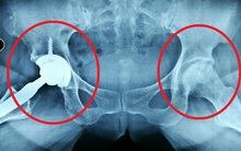 Tác hại kinh khủng của rượu khiến người uống hoại tử 2 chỏm xương đùi