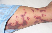 Đừng coi thường đau đầu và sốt mùa này, đó chính là dấu hiệu của bệnh viêm não mô cầu nguy hiểm đó!