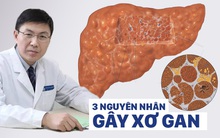 Giáo sư y khoa: 3 nguyên nhân gây xơ gan hàng đầu, biết sớm sẽ tránh được ung thư