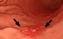 Ung thư có hơn 100 loại nhưng 4 loại sau gây đau đớn nhất