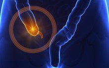 Một số cảnh báo sớm về bệnh ruột thừa