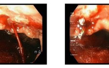 Ăn uống "chung đụng" như chung đũa, dùng chung nước chấm dễ nhiễm khuẩn gây ung thư dạ dày