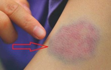 Thấy vết bầm tím trên da mãi không khỏi, hãy cảnh giác với những căn bệnh sau