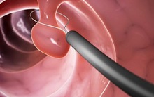 Ung thư đại trực tràng: Có triệu chứng đi khám ngay, phát hiện sớm dễ chữa khỏi