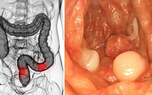Những dấu hiệu giúp tự nhận biết sớm ung thư đại tràng: Đừng lờ đi dù chỉ là 1 dấu hiệu