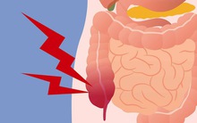 Chỉ mất 5 phút mỗi ngày lọc sạch ruột già trong 1 tuần theo cách của TS Mỹ