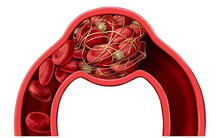 8 nhóm người này có nguy cơ bị cục máu đông nguy hiểm cao hơn những người khác