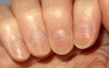 Ung thư đừng để quá muộn: BS viện Việt Đức cảnh báo 20 dấu hiệu nên đi khám ung thư