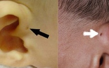 Thấy con có lỗ nhỏ ở vành tai, mẹ tưởng con thông minh nhưng sự thật là...