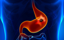 Nguyên nhân gây viêm loét dạ dày, tăng nguy cơ dẫn đến bệnh ung thư: Điều thứ 7 rất nhiều người mắc