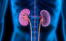 Bí quyết của TS nổi tiếng người Mỹ: Uống nước chanh nóng và tránh xa 4 loại thực phẩm quen thuộc để loại bỏ nguy cơ sỏi thận