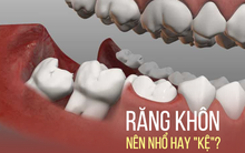 Răng khôn: Mỗi lần mọc lại một lần đau, khi nào nên nhổ?